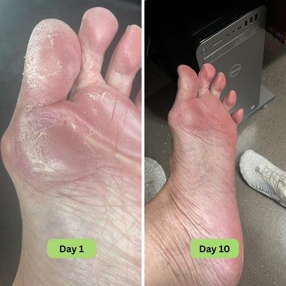 Vanuca™ Tea Tree Oil Antifungal Soap Bar